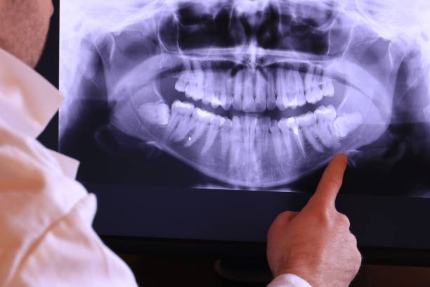 Best Emergency Wisdom Teeth Removal in Timberlake, VA